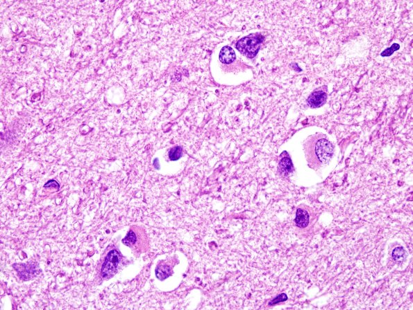 2C7 MSA (Case 2) L21 Precentral gyrus H&E 5