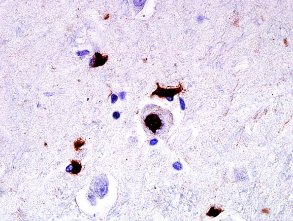 2D3 MSA (Case 2) L21 Precentral gyrus (neuron) pSYN 5