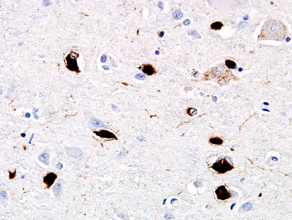 2D4 MSA (Case 2) L21 Precentral gyrus pSYN 13