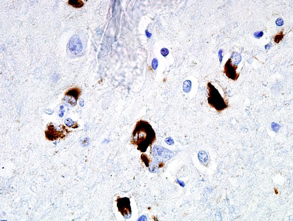 2D5 MSA (Case 2) L21 Precentral gyrus pSYN 4