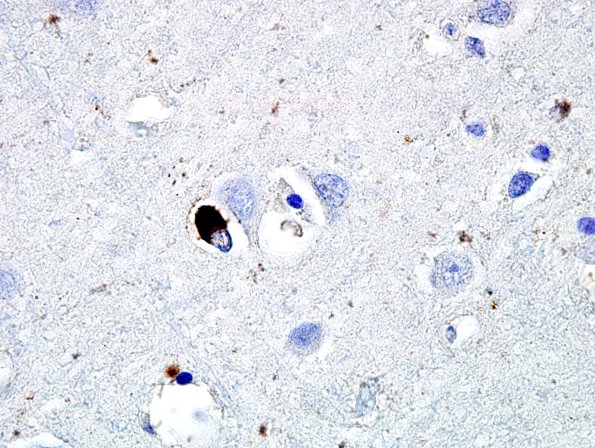 2D6 MSA (Case 2) L21 Precentral gyrus pSYN 7