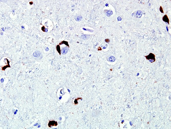 2D7 MSA (Case 2) L21 Precentral gyrus pSYN 10