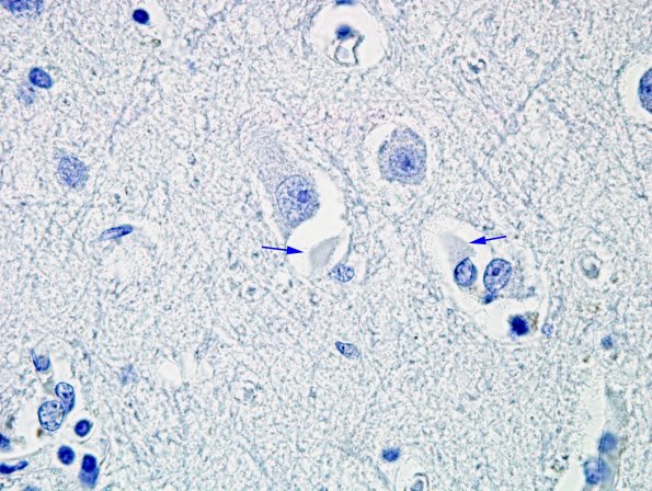 2D8 MSA (Case 2) L21 Precentral gyrus PHF-1 2 copy