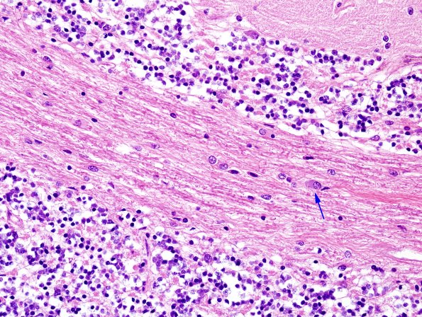 2E3 MSA (Case 2) L14 Cerebellum H&E 5 copy