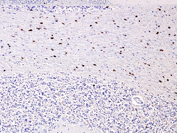 2F2 MSA (Case 2) L14 Cerebellum pSYN 3