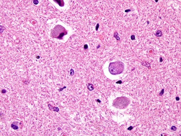 2G MSA (Case 2) L12 Medulla ION H&E 1