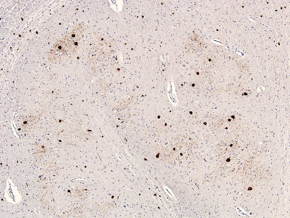 2H2 MSA (Case 2) L12 Medulla ION pSYN 16