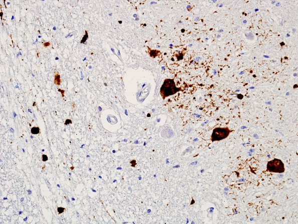 2H3 MSA (Case 2) L12 Medulla ION pSYN 14