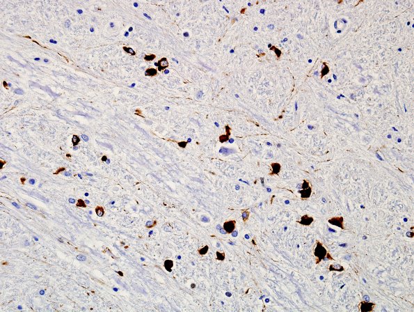 2H4 MSA (Case 2) L12 Medulla ION H&E 4