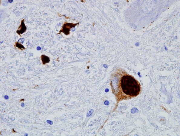 2H5 MSA (Case 2) L12 Medulla ION pSYN 5