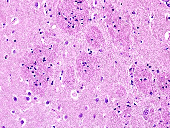 2I1 MSA (Case 2) L6 Basal Ganglia H&E 1