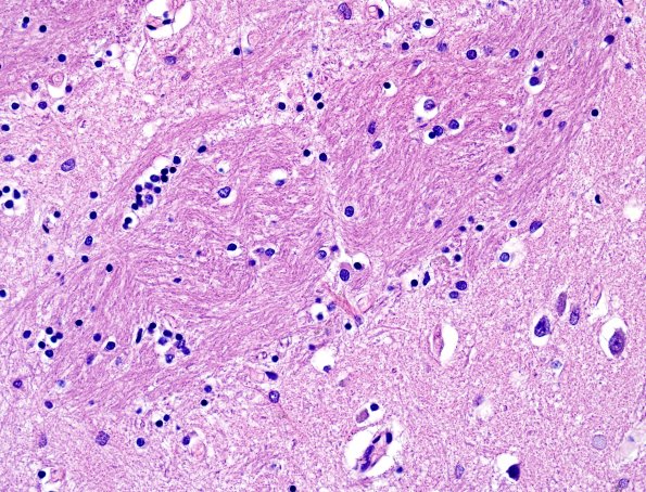 2I2 MSA (Case 2) L17 Basal Ganglia H&E 2