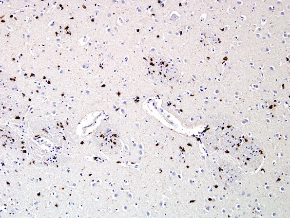 2J1 MSA (Case 2) L6 Basal Ganglia pSYN 6