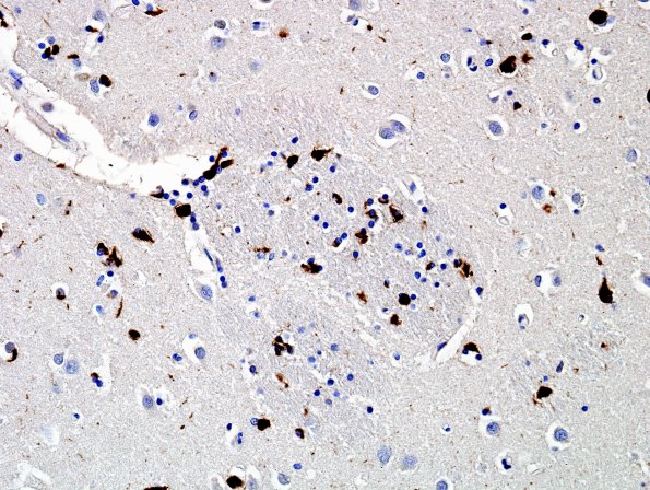 2J2 MSA (Case 2) L6 Basal Ganglia pSYN 7