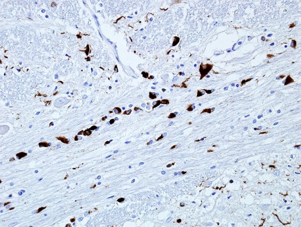 2L3 MSA (Case 2) L11 pSYN 5