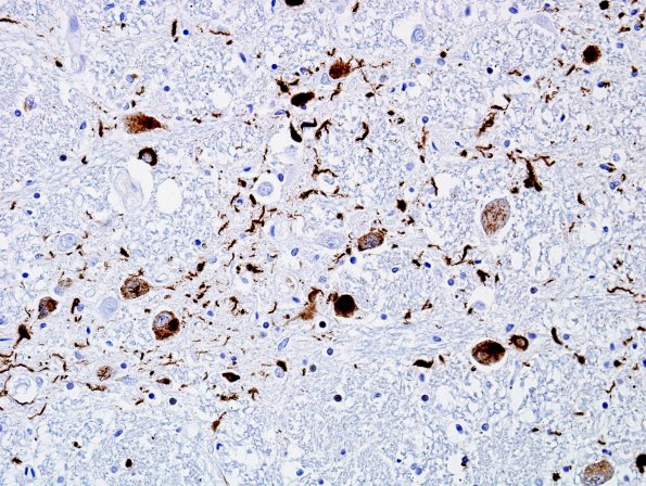 2L7 MSA (Case 2) L11 pSYN 15