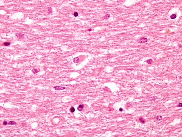 3A2 MSA (Case 3) Pons H&E 4