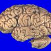 4A1 Multiple System Atrophy (MSA) (Case 4) Gross_1