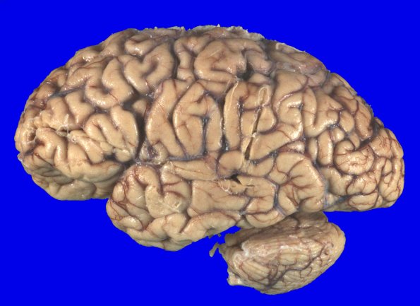 4A1 Multiple System Atrophy (MSA) (Case 4) Gross_1