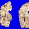 4A2 Multiple System Atrophy (MSA) (Case 4) Gross_4