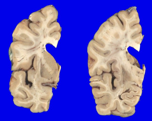 4A2 Multiple System Atrophy (MSA) (Case 4) Gross_4