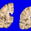 4A4 Multiple System Atrophy (MSA) (Case 4) Gross_6