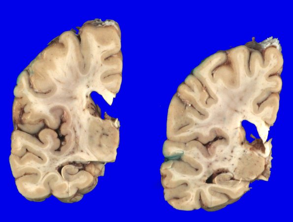 4A4 Multiple System Atrophy (MSA) (Case 4) Gross_6