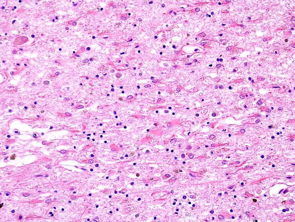 4B3 MSA (Case 4) Basal Ganglia L17 putamen H&E 8