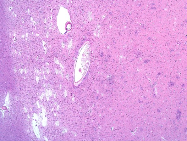 4B5 MSA (Case 4) Basal Ganglia L6 H&E 5