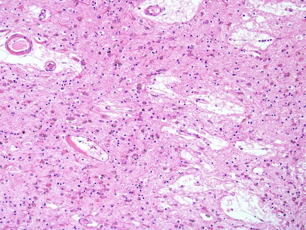 4B6 MSA (Case 4) Basal Ganglia L6 H&E 7