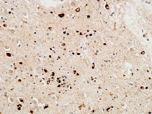 4C2 MSA (Case 4) Basal Ganglia L6 pSYN 2