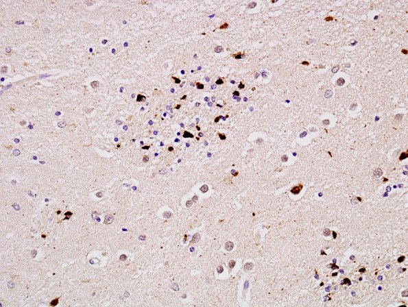 4C3 MSA (Case 4) Basal Ganglia L17 pSYN 3