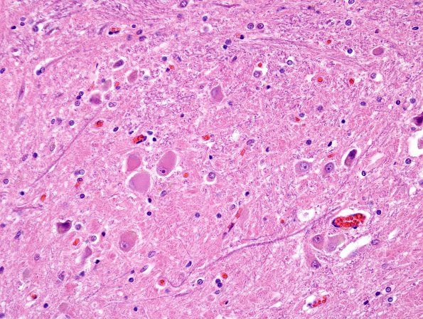 4D MSA (Case 4) Pons L11 H&E 1