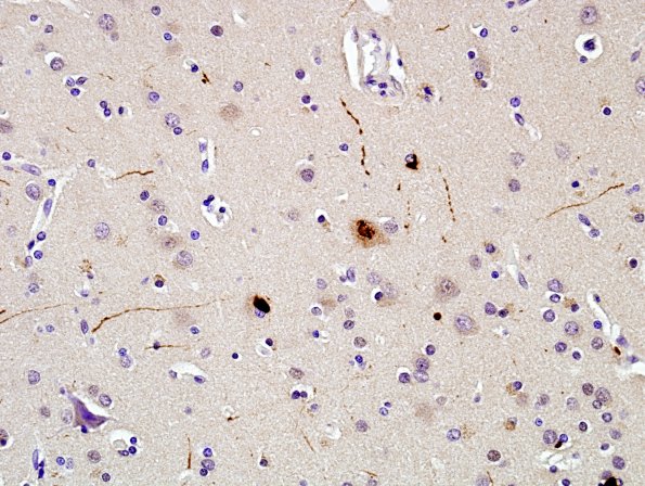 4H1 MSA (Case 4) gray matter pSYN 1