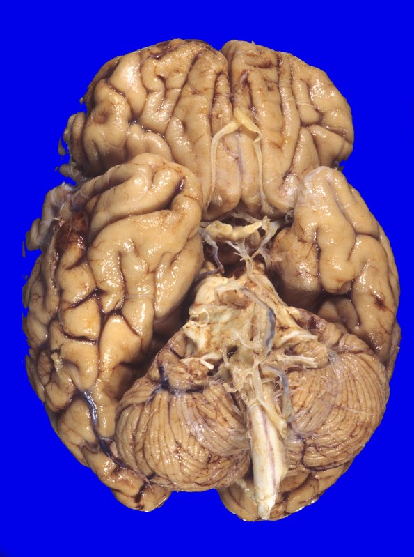 5A1 MSA (Case 5) gross 1