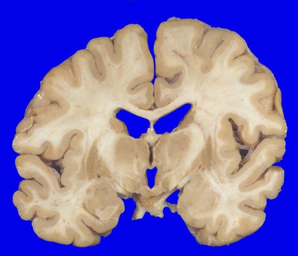 5A2 MSA (Case 5) 1