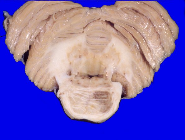 5A3 Telangiectasis (Case 5) 2