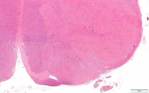 5E1 MSA (Case 5) Medulla N8 2X scale