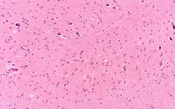 5E2 MSA (Case 5) Medulla N8 ION 20X