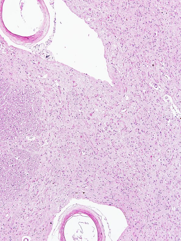 6B2 MSA (Case 6) gliotic putamen H&E 3.jpg