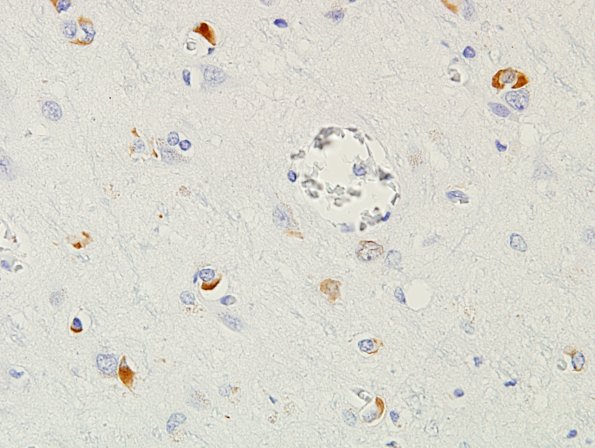 6F MSA (Case 6) cerebral cortex H&E 2.jpg