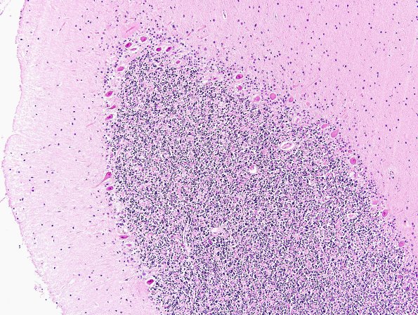 6G MSA (Case 6) Purkinge cell preservation H&E 1.jpg