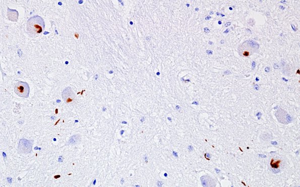 6H2 MSA (Case 6) Inferior Olive (ION) pSYN 2.jpg