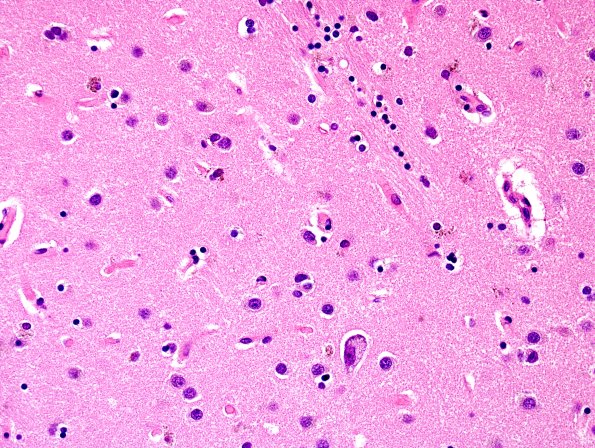 7B MSA (Case 7) N2 H&E 1 anterior putamen.jpg