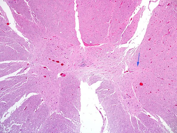 7D MSA (Case 7) N11 H&E 4X.jpg