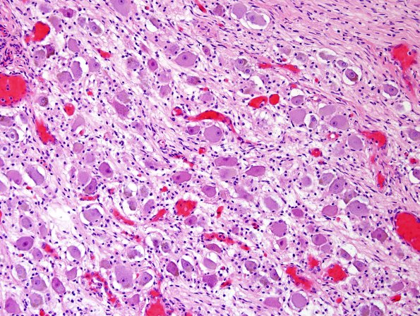 7E MSA (Case 7) N17 L chain SNS ganglia H&E 3.jpg