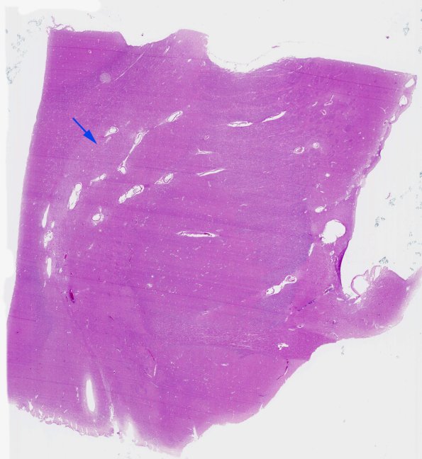 8B1 Multiple system atrophy (MSA, Case 8) BG H&E whole mount copy