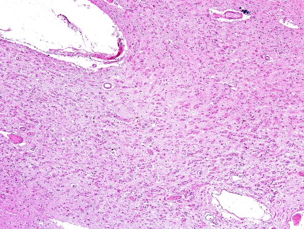 8B2 Multiple system atrophy (MSA, A14-113) BG H&E 7.jpg