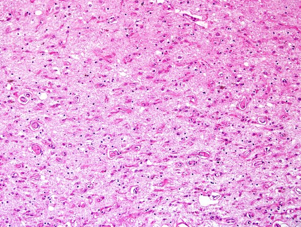 8B3 Multiple system atrophy (MSA, Case 8) BG H&E 4.jpg