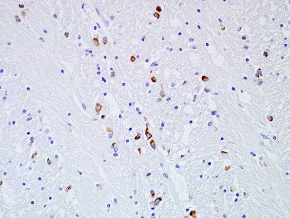 8B4 Multiple system atrophy (MSA, Case 8) BG pSYN 2.jpg